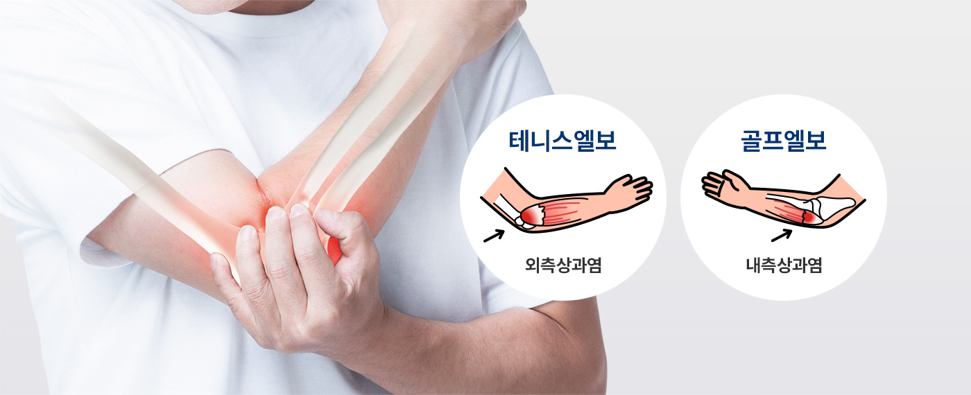 외측상과염 - 테니스엘보, 내측상과염 - 골프엘보